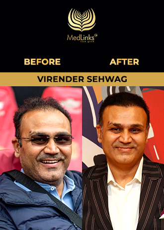 Simon Doull hair transplant before and after